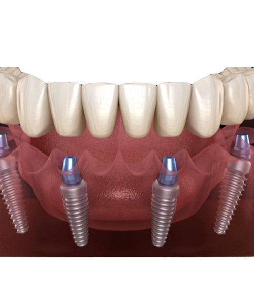 cuántos implantes necesitas para una dentadura completa fija