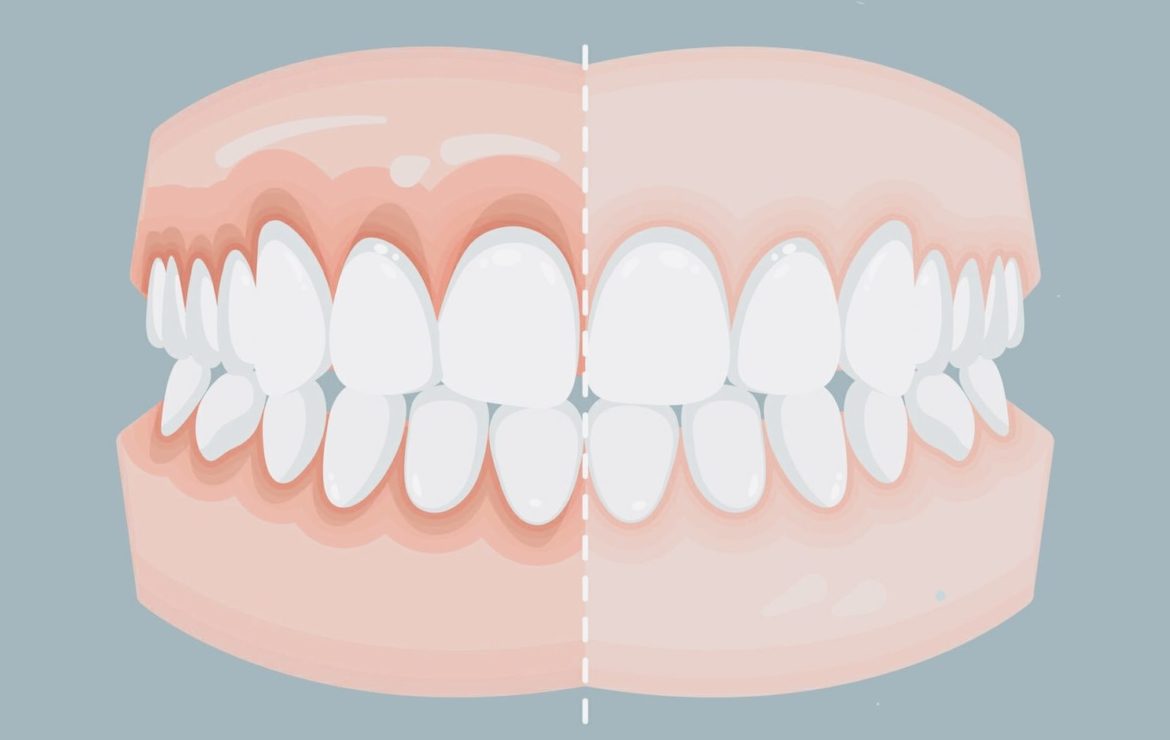 ¿Por qué se retraen las encías?
