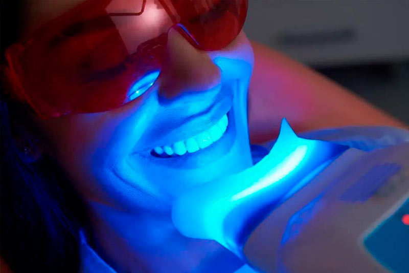 Blanqueamiento Dental Combinado