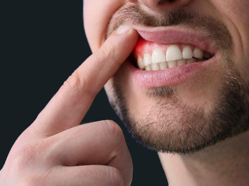 ¿Qué es la periodontitis, cuáles son sus causas y cómo se trata?