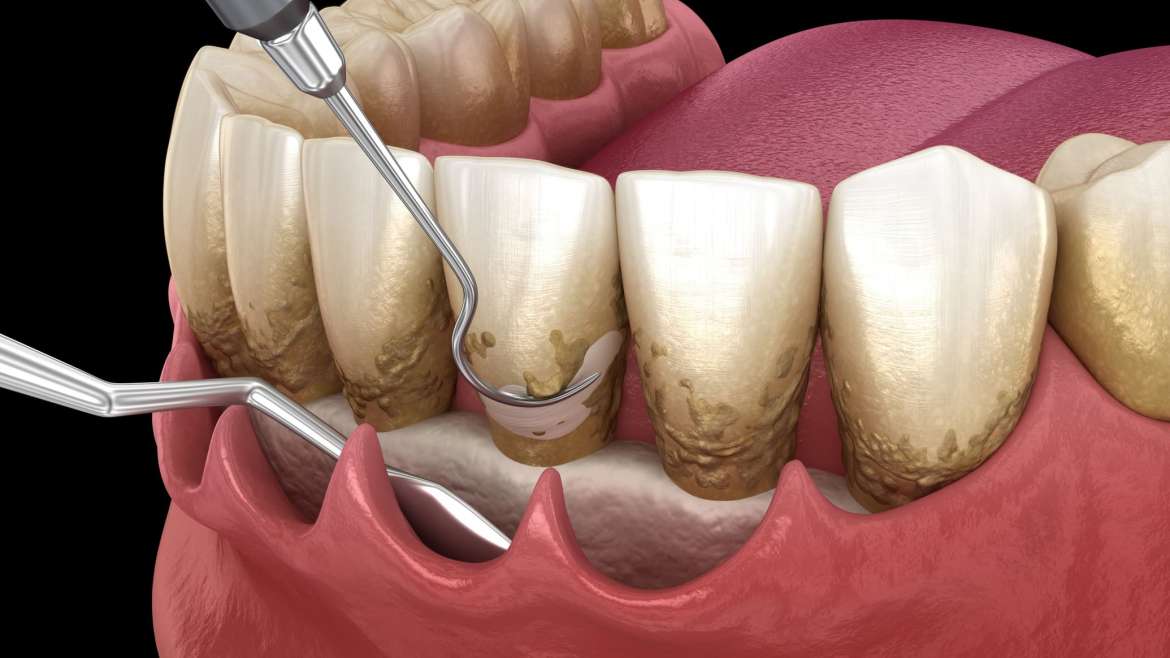 Curetaje dental: qué es, cuándo es necesario y cómo es el procedimiento