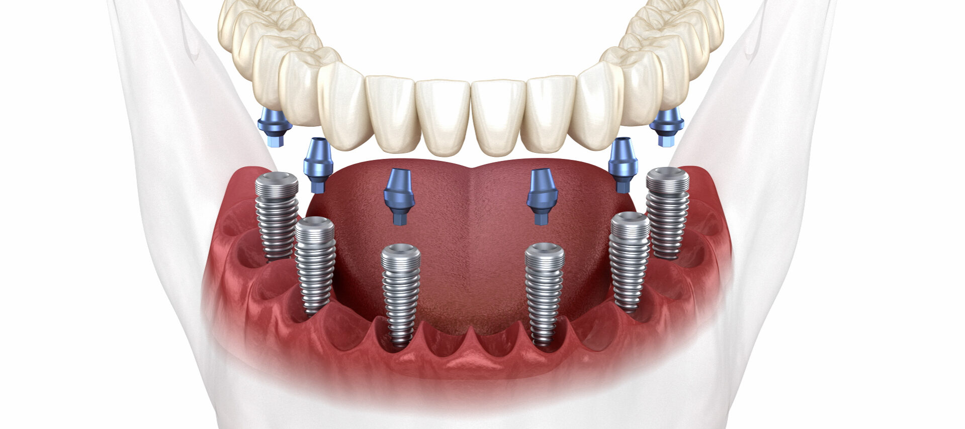 All-on-6: qué es, ventajas y cómo recuperar tu sonrisa con dientes fijos en un día