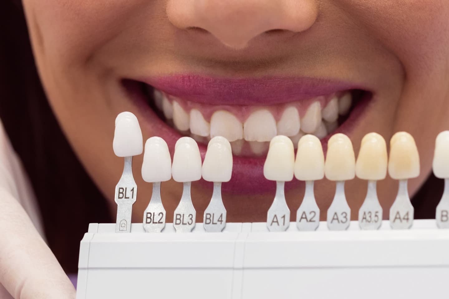 Tipos de carillas dentales: ¿porcelana o composite? Guía completa para elegir la mejor opción