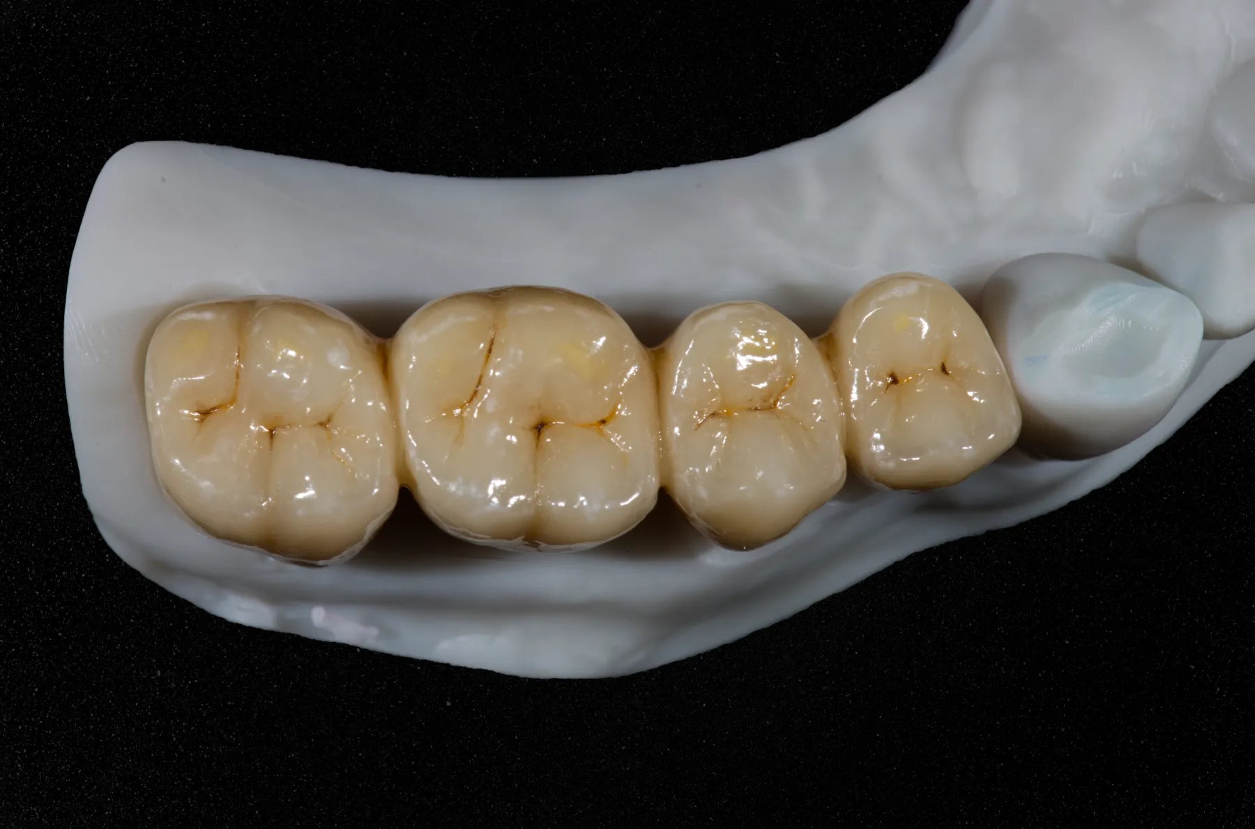 Zirconio en odontología: restauraciones de alta estética y diferencias con metal-porcelana