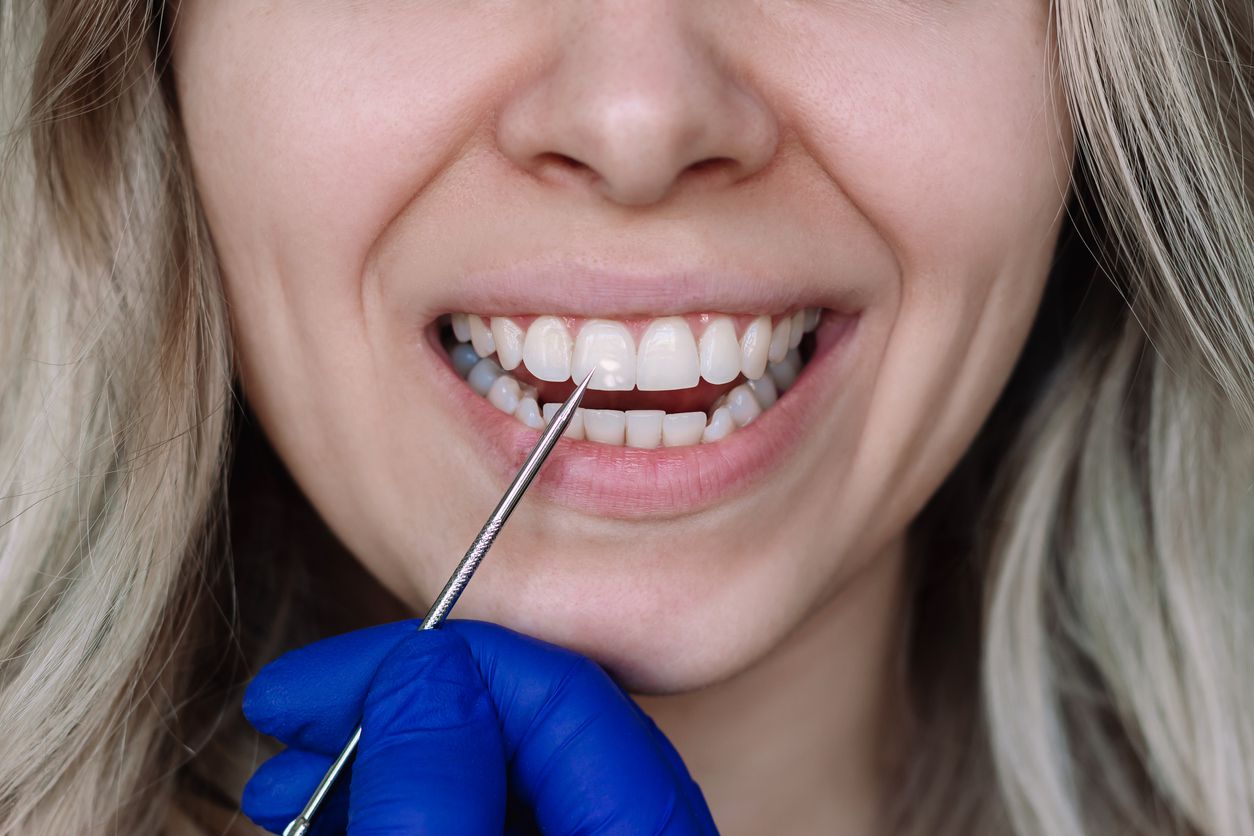 Manchas blancas en los dientes: qué las causa y cómo se eliminan