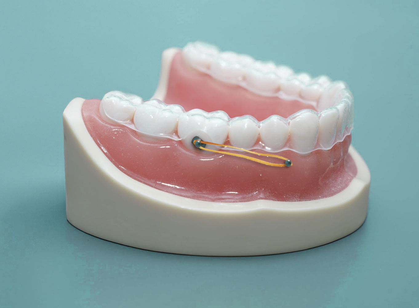 ¿Qué son los microtornillos en ortodoncia invisible y para qué sirven?