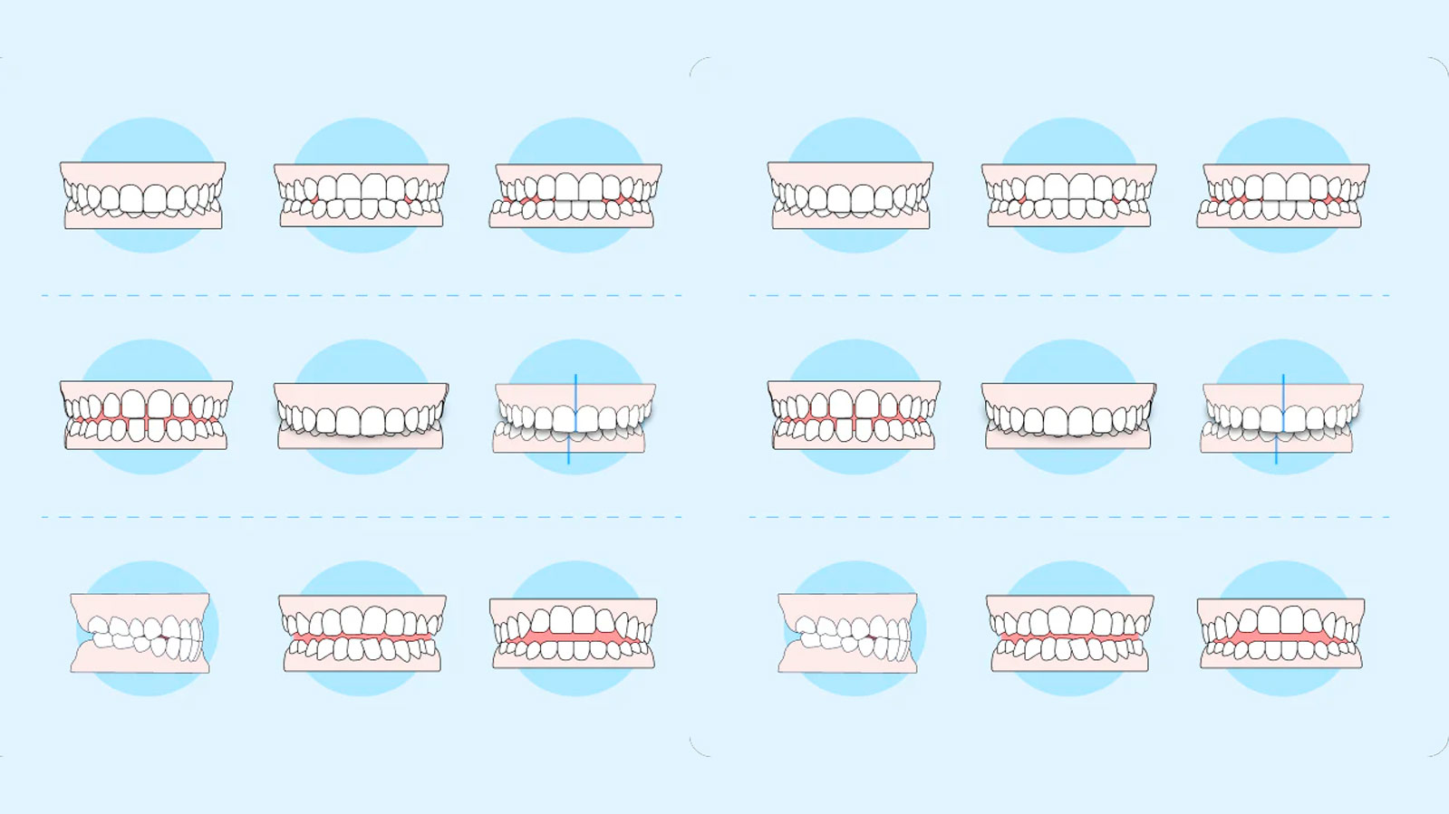 Tipos de maloclusiones dentales: Clase I, Clase II y Clase III