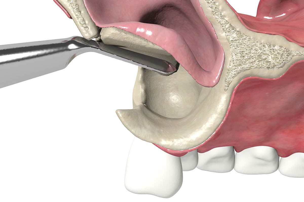Elevación del seno maxilar: qué es, cuándo se necesita y cómo permite colocar implantes dentales